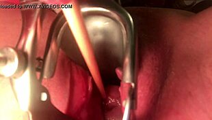 Cervix Stretched And Sounded With Deep Insertion